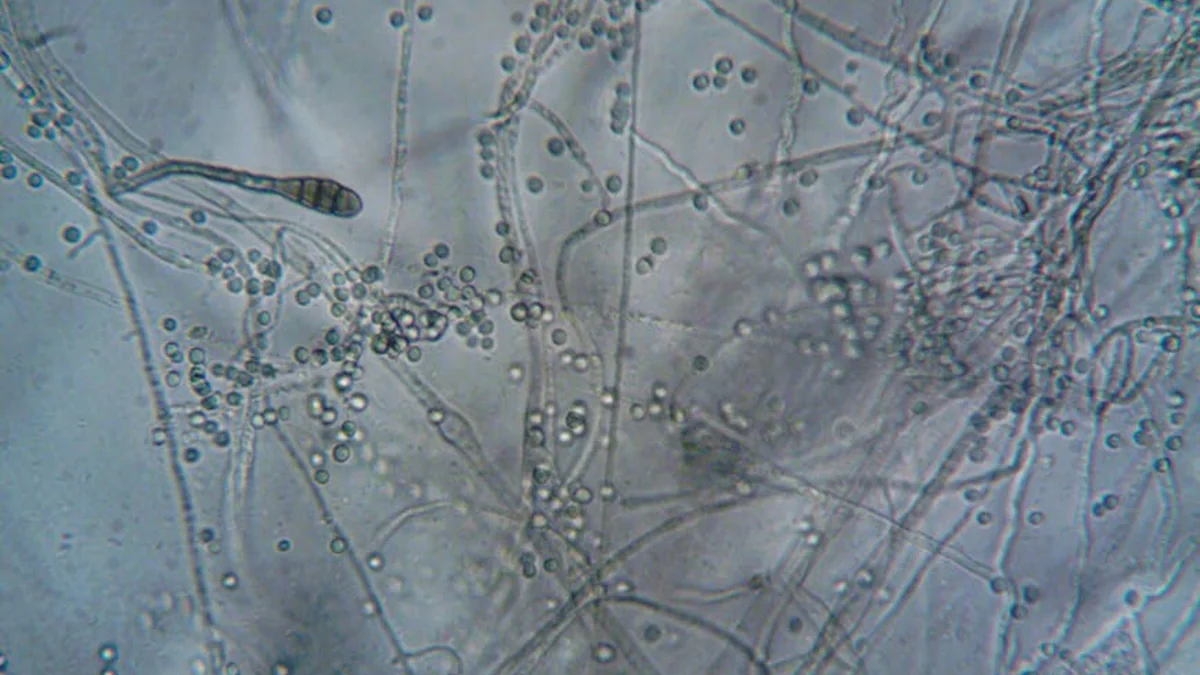 Gonorrhea, chlamydia, or bacterial/yeast vaginal infection? How to tell the difference